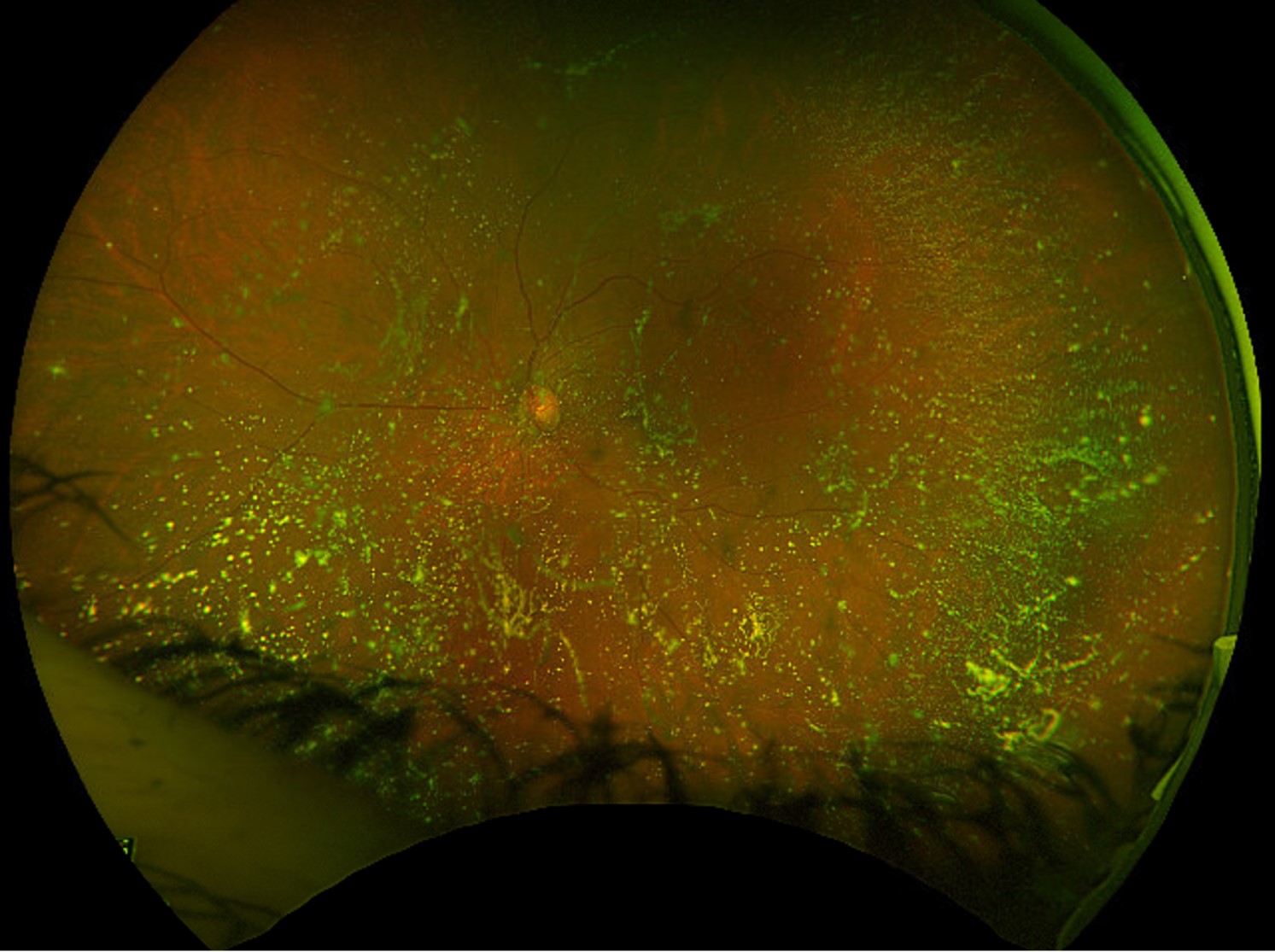 Clinical eye photograph illustrating Asteroid Hyalosis Clinical Significance