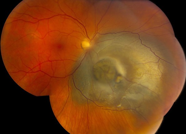 Choroidal Melanoma