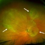 Clinical eye photograph illustrating Acute Syphilitic Posterior Placoid Chorioretinitis