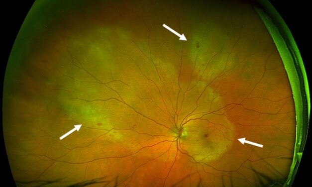 Acute Syphilitic Posterior Placoid Chorioretinitis: A Distinct Pattern Behind a Familiar Cause