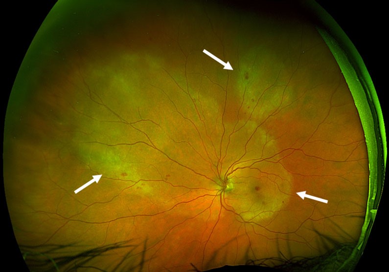 Acute Syphilitic Posterior Placoid Chorioretinitis: A Distinct Pattern Behind a Familiar Cause