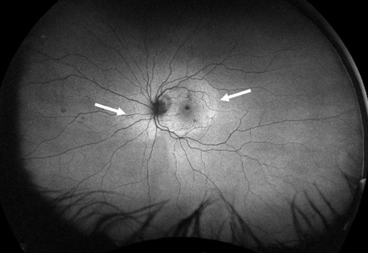 Clinical eye photograph illustrating Acute Syphilitic Posterior Placoid Chorioretinitis