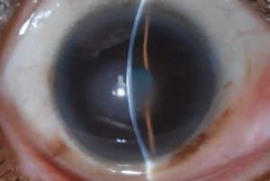 Fuchs Endothelial Corneal Dystrophy