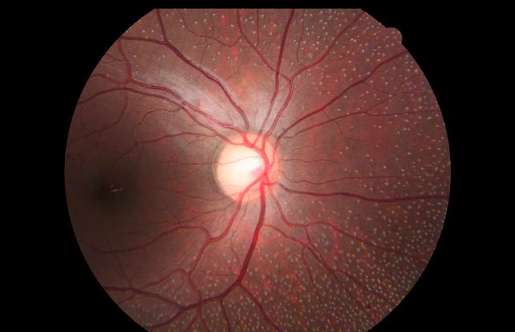 Congenital Stationary Night Blindness