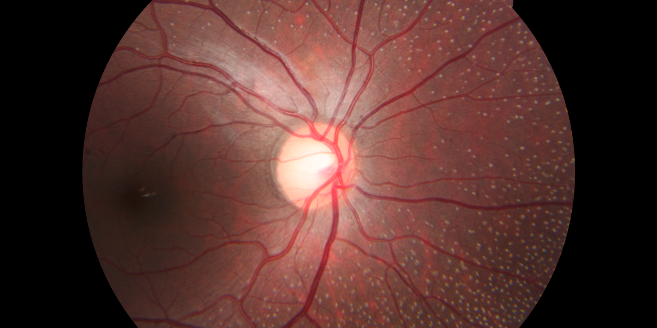 Congenital Stationary Night Blindness: Why ‘Stationary’ Is the Key Word