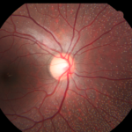 Congenital Stationary Night Blindness