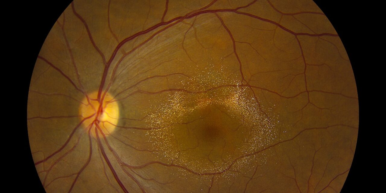 Canthaxanthin Retinopathy: A Golden Ring From a Tanning Pill