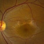 Canthaxanthin Retinopathy