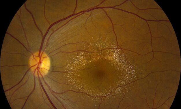 Canthaxanthin Retinopathy: A Golden Ring From a Tanning Pill