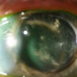 Chronic Postoperative Endophthalmitis