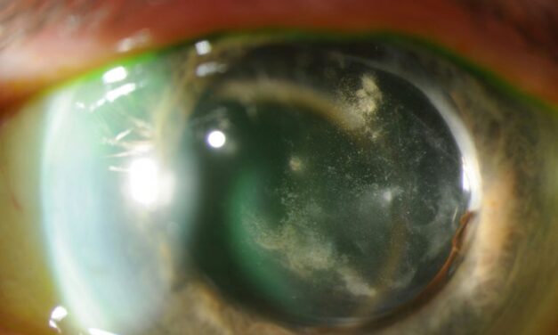Chronic Postoperative Endophthalmitis: The Infection Mistaken for Recurrent Uveitis