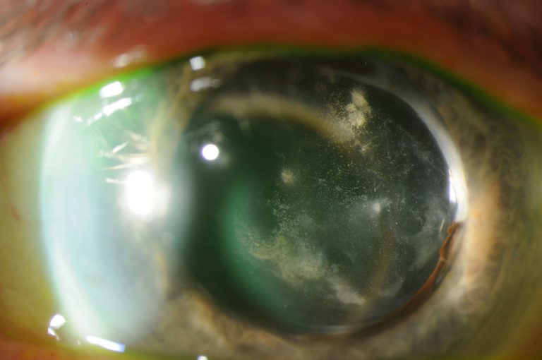 Chronic Postoperative Endophthalmitis: The Infection Mistaken for Recurrent Uveitis
