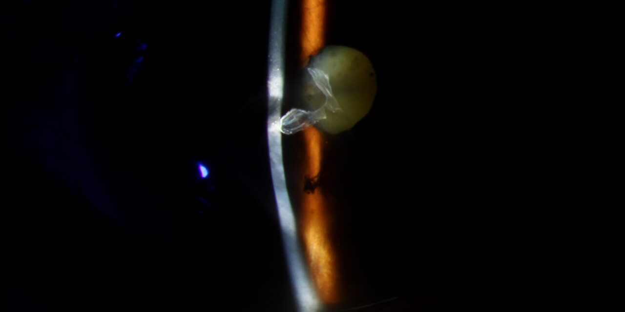 Descemetocele: One Thin Layer From Perforation