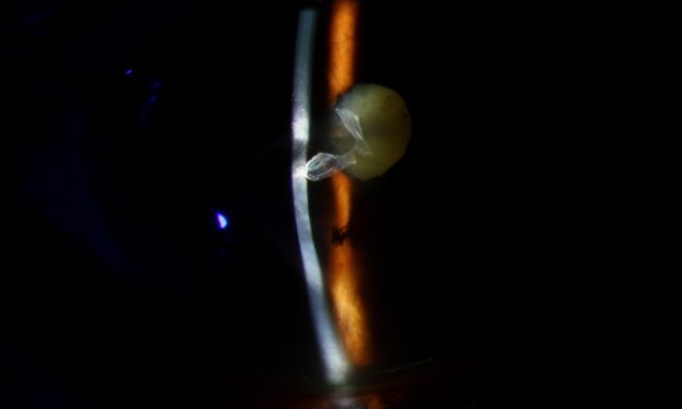 Descemetocele: One Thin Layer From Perforation