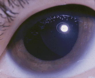 Weill-Marchesani Syndrome