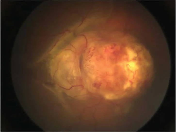 Medulloepithelioma