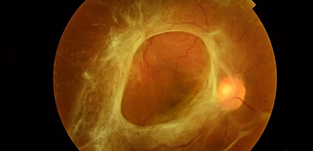 Tractional Retinal Detachment