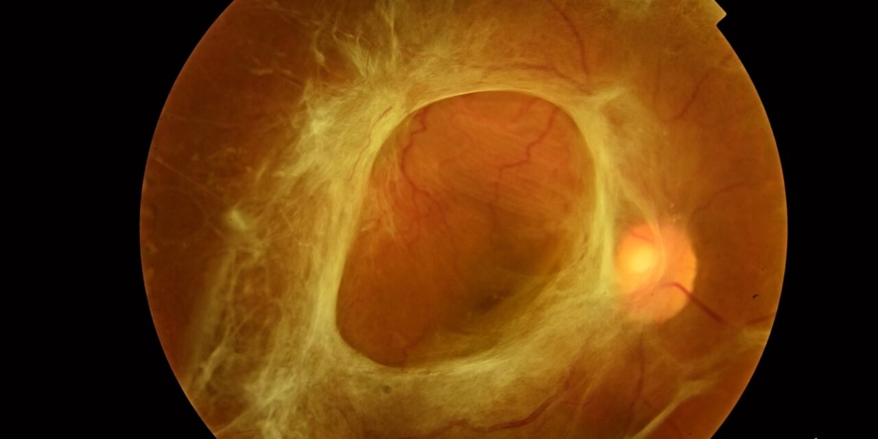 Tractional Retinal Detachment: When Membranes, Not Breaks, Pull the Retina