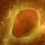 Tractional Retinal Detachment