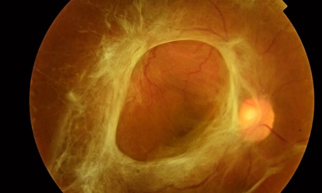 Tractional Retinal Detachment: When Membranes, Not Breaks, Pull the Retina