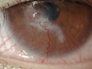 Phlyctenular Keratoconjunctivitis