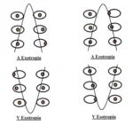 A-Pattern and V-Pattern Strabismus