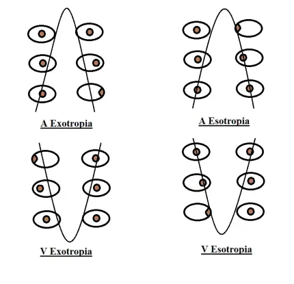 A-Pattern and V-Pattern Strabismus: The Deviation That Changes With Gaze