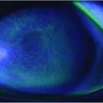 Photokeratitis
