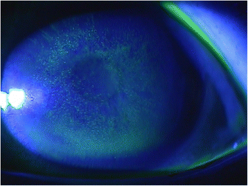 Photokeratitis: A Sunburned Cornea Hours Later