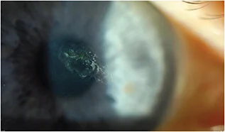 Recurrent Corneal Erosion