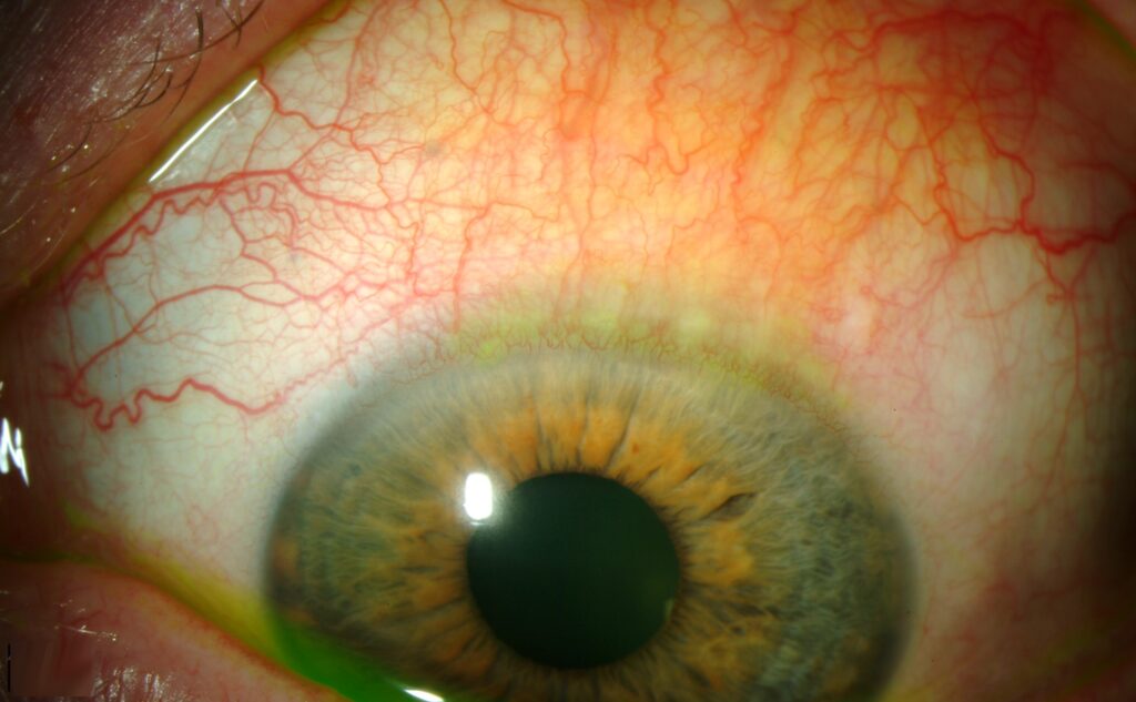 Superior Limbic Keratoconjunctivitis