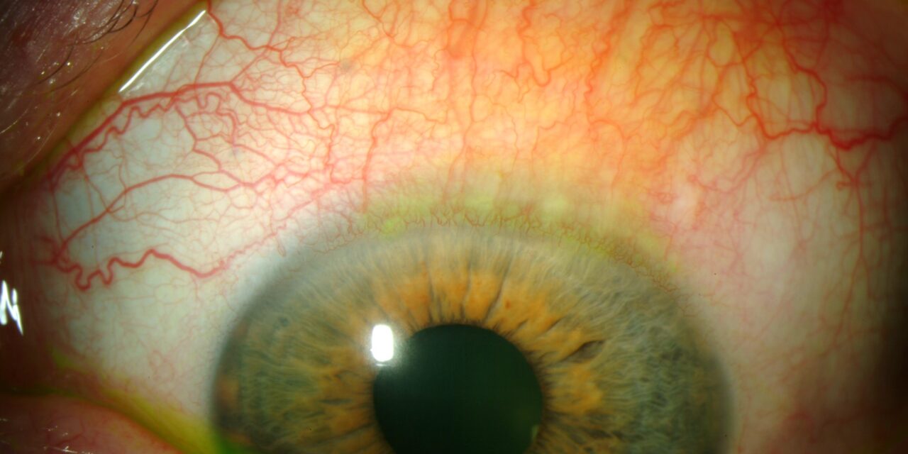 Superior Limbic Keratoconjunctivitis: The Redness Only Above