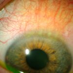 Superior Limbic Keratoconjunctivitis