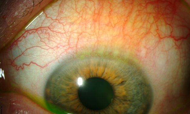 Superior Limbic Keratoconjunctivitis: The Redness Only Above