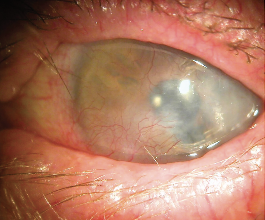 Corneal Neovascularization