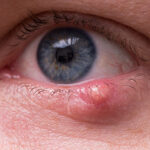 Sebaceous Carcinoma