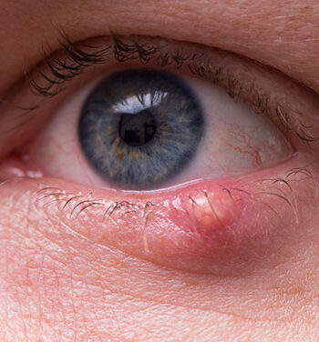 Sebaceous Carcinoma: The Great Masquerader of Eyelid Disease