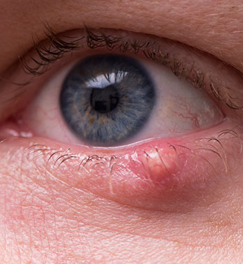 Sebaceous Carcinoma