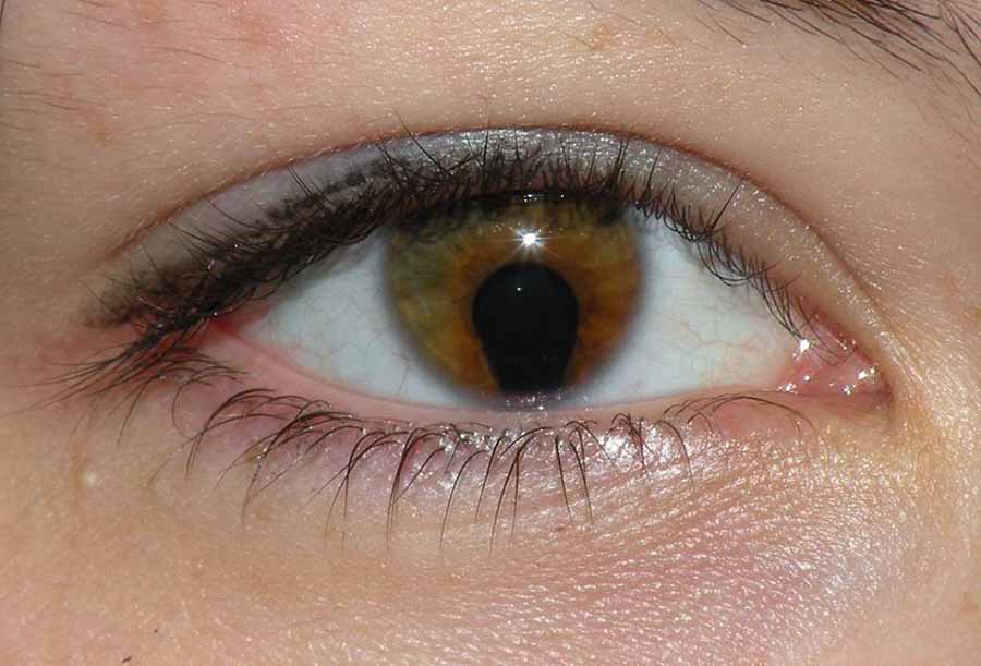 Cat Eye Syndrome