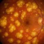 Ocular Tuberculosis