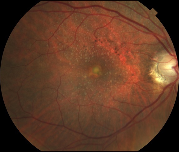 Adult-onset vitelliform maculopathy: macular pigmentary mottling surrounding the vitelliform lesion