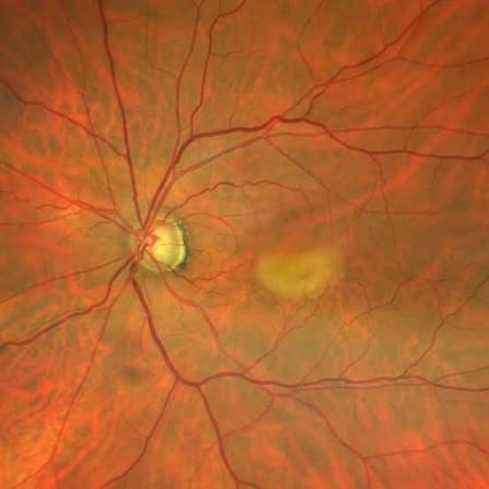 Adult-Onset Vitelliform Maculopathy: Not Best Disease in Disguise