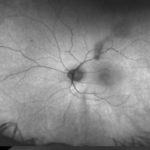 Alstrom syndrome: fundus photograph showing macular atrophy from cone-rod dystrophy