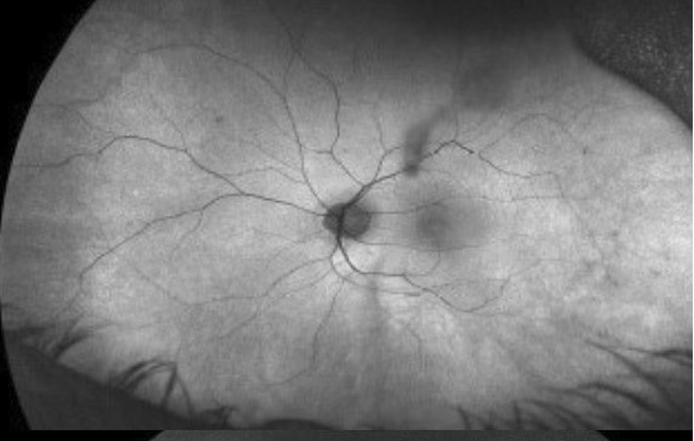 Alstrom Syndrome Macular Atrophy Fundus Alstrom syndrome: fundus photograph showing macular atrophy from cone-rod dystrophy