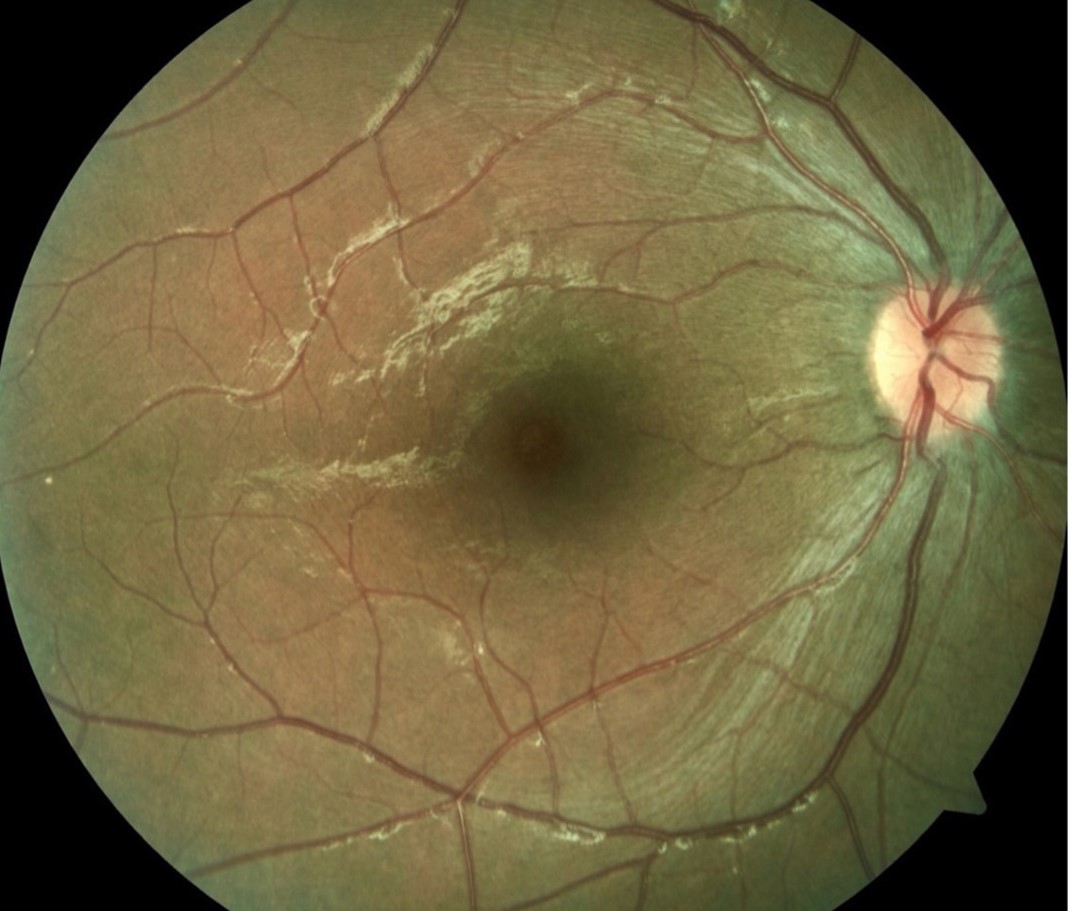 Alstrom Syndrome Retinal Atrophy Disc Pallor Alstrom syndrome: color fundus photograph showing central retinal pigment epithelial atrophy and optic disc pallor