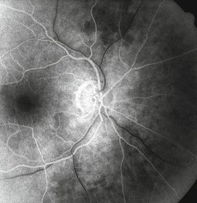 Amaurosis fugax: fluorescein angiogram of the optic disc and retinal vessels used to assess retinal perfusion