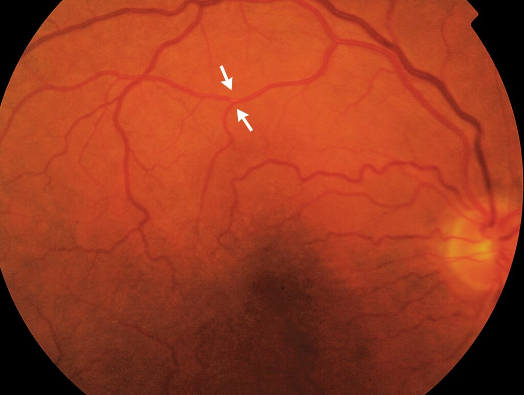 Amaurosis fugax: fundus photograph with arrows marking an embolus at a retinal arteriolar bifurcation