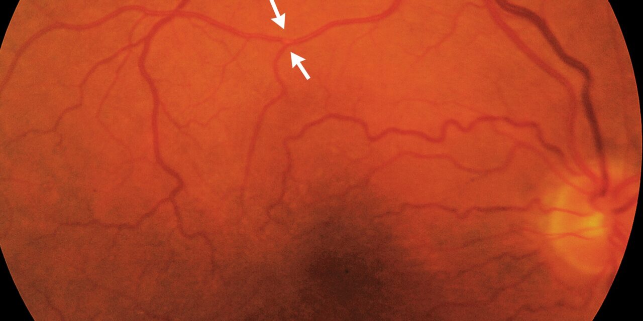 Amaurosis Fugax: Transient Monocular Vision Loss Is a Stroke Warning Until Proven Otherwise