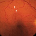 Amaurosis fugax: fundus photograph with arrows marking an embolus at a retinal arteriolar bifurcation