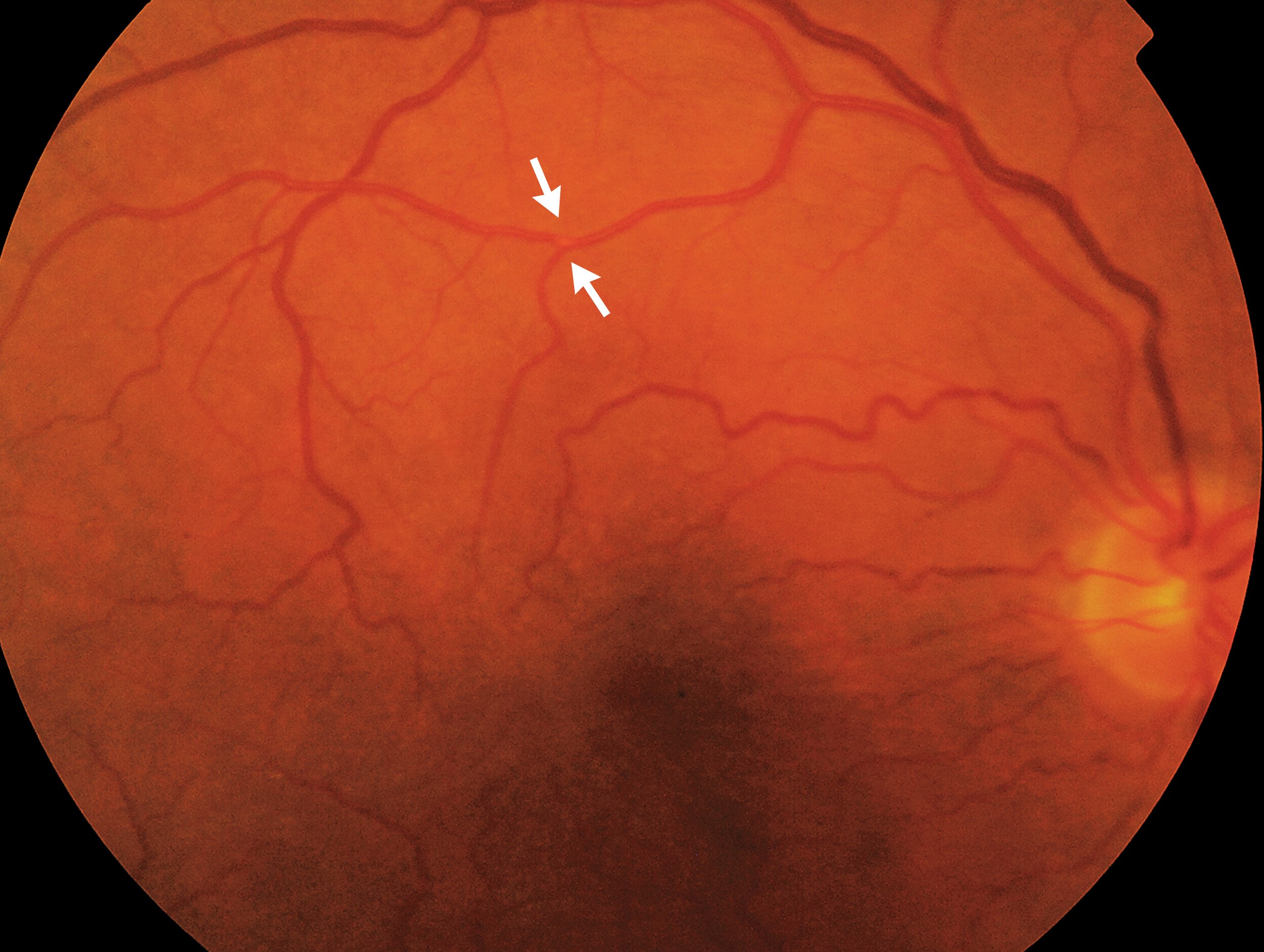 Amaurosis fugax: fundus photograph with arrows marking an embolus at a retinal arteriolar bifurcation